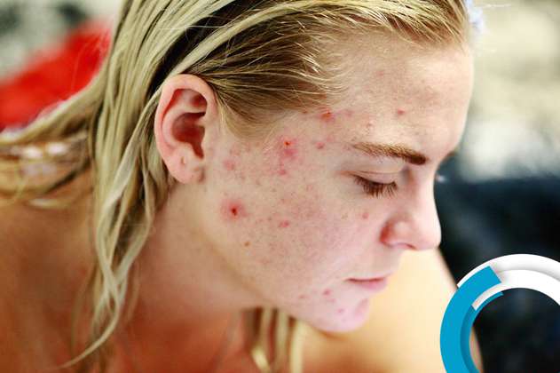 Nueve recomendaciones para tratar las manchas y cicatrices del acné