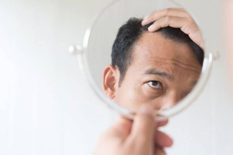 Alopecia: todo sobre la pastilla aprobada que cura en un 90% la calvicie 