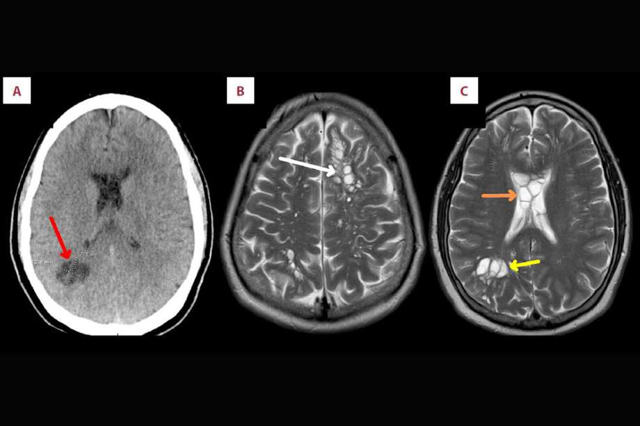 Varios exámenes muestran las lesiones cerebrales del hombre por cuenta de la neurocisticercosis.