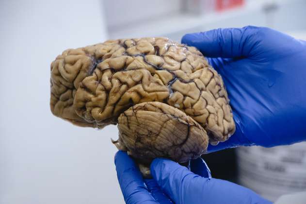 Preocupación por medicamento contra el alzhéimer: estaría encogiendo el cerebro