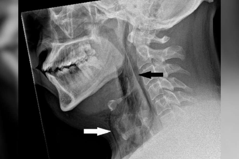 Una radiografía del cuello del hombre reveló que tenía bolsas de aire atrapadas debajo de la piel de su cuello, como lo muestran las flechas de arriba.