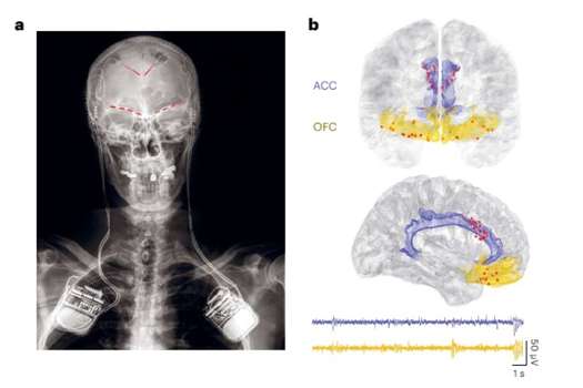 Esta radiografía frontal de uno de los participantes muestra electrodos cerebrales implantados, representados por las líneas rojas, conectados a implantes de registro en cada lado.