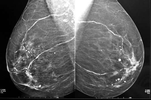 Según los investigadores el 52% de los cánceres detectados en la pantalla de las mamografías entre mujeres holandesas serían falsos diagnósticos.  / Wikicommons.