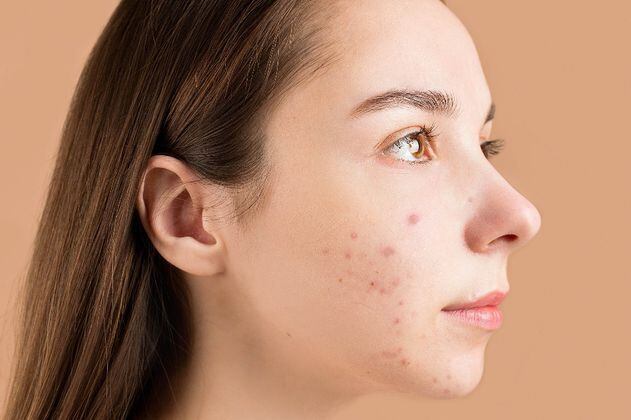 Salud y piel: Estos son los alimentos que pueden generar acné
