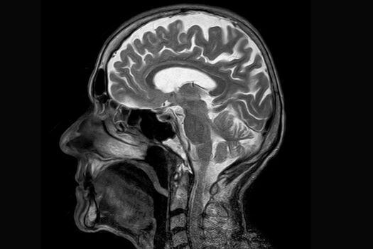 Los síntomas neuropsiquiátricos están entre los más reportados tras superar el COVID-19 agudo. El origen de está relación aún no es claro.  