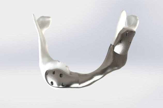 Trasplantan por primera vez en el mundo una mandíbula de titanio impresa en 3D