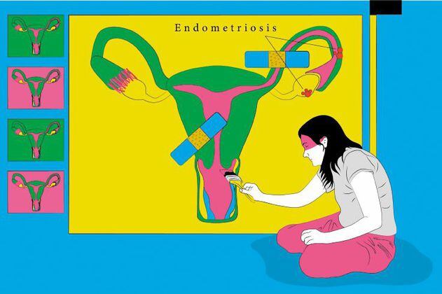 Endometriosis: cuando la normalización del dolor menstrual invisibiliza una enfermedad 