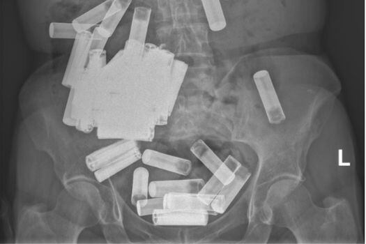 Radiografía de las baterías alojadas en el abdomen de la mujer.
