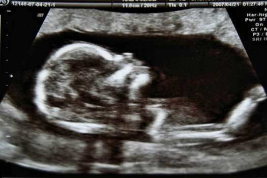 Los investigadores examinaron 180 escaneos de 99 fetos a las 32 semanas y a las 36 semanas.