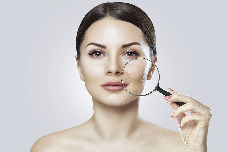 Cómo eliminar las manchas del acné en el rostro