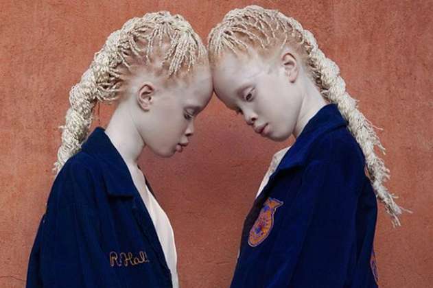 Lara y Mara, las gemelas albinas que muestran la belleza de la diversidad