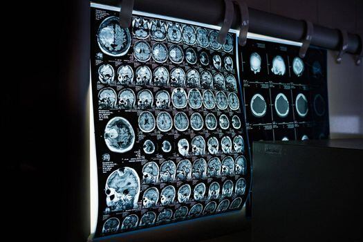La resonancia magnética ponderada por difusión permite estudiar la inflamación cerebral in vivo