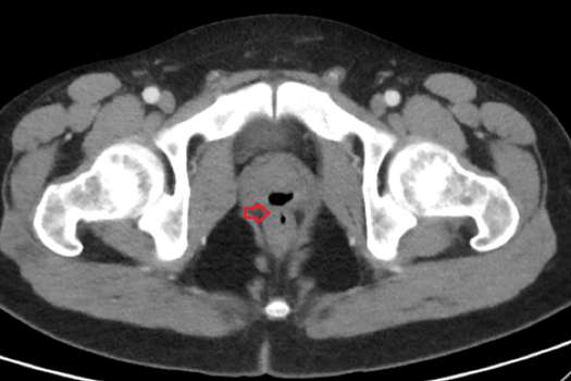 Imagen de la tomografía computarizada que le hicieron al paciente y que permitió detectar su problema.