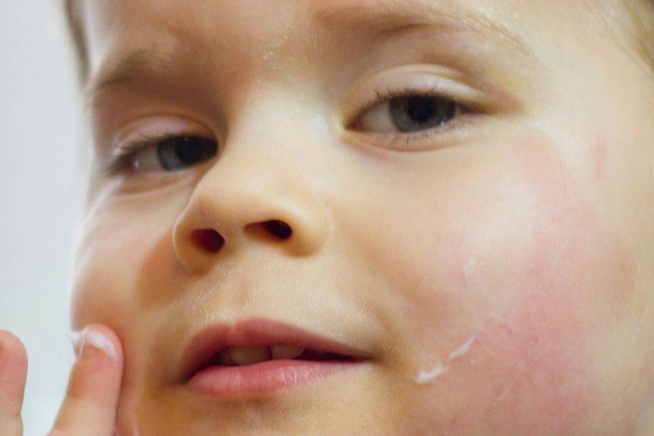 Dermatitis de niños. dermatitis atópica. niños, cara roja