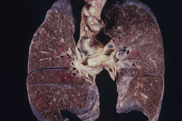 Tras cuatro décadas se puede acortar el tratamiento de la tuberculosis