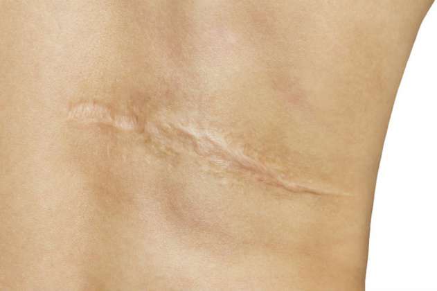¿Qué tipos de cicatrices existen y cómo tratarlas? 