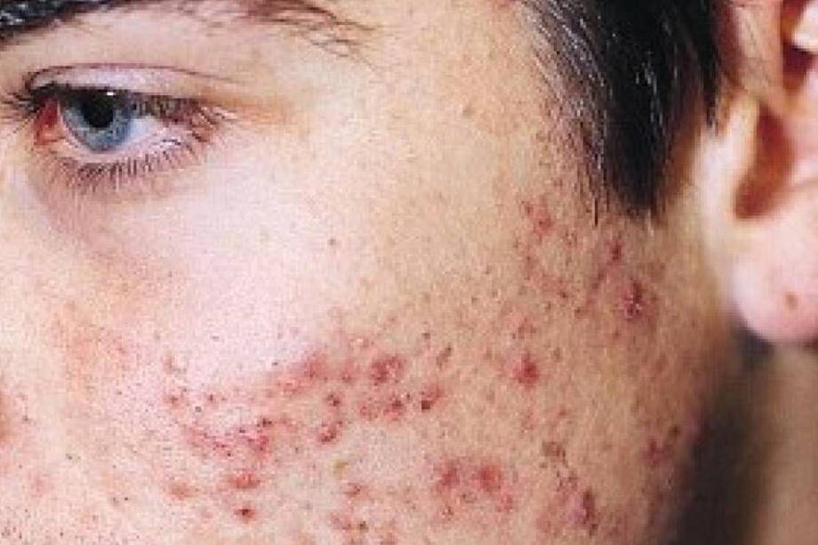 El acné afecta especialmente en la adolescencia, aunque no es una condición ajena a los adultos.