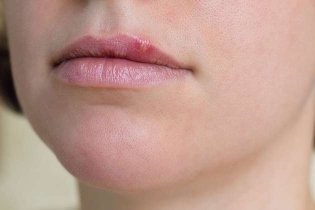 Científicos utilizan la edición de genes para impedir contagio de fuegos en los labios 