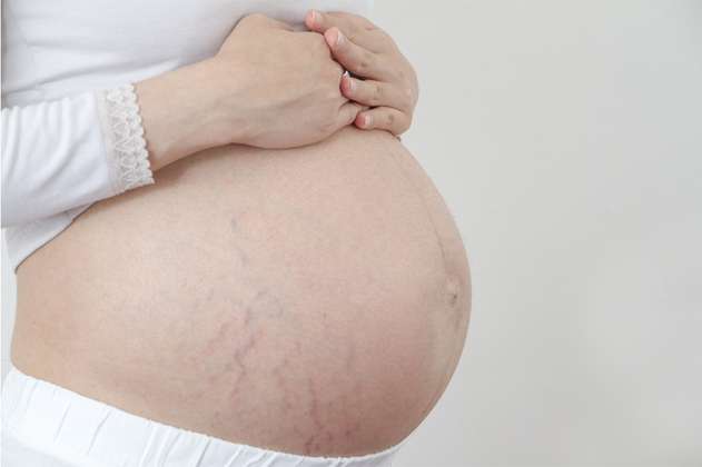 ¿Qué son las estrías y cómo evitarlas en el embarazo?