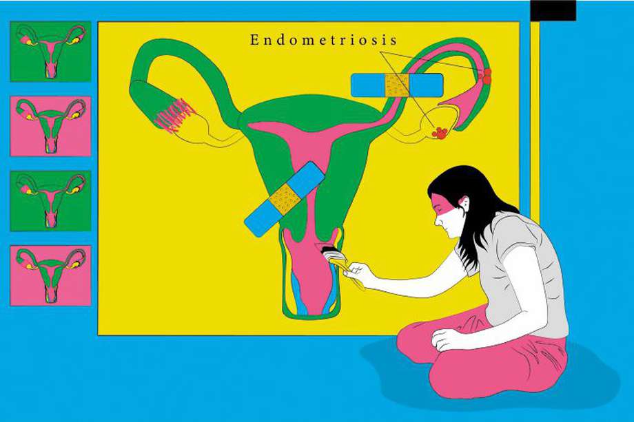 Endometriosis.