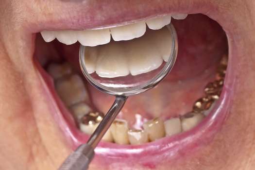 El daño en la estructura de los dientes puede variar en función del diseño y la fijación de la joya.
