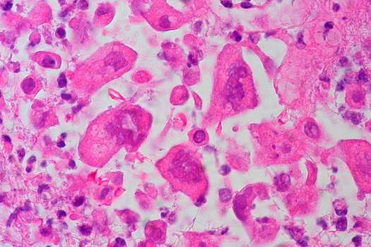 El virus del herpes modificado no daña las células normales del cuerpo, pero cuando es inyectado en tumores se reproduce y libera una sustancia que ayuda a combatir el cáncer. Pie de foto: / Flickr – Ed Uthman