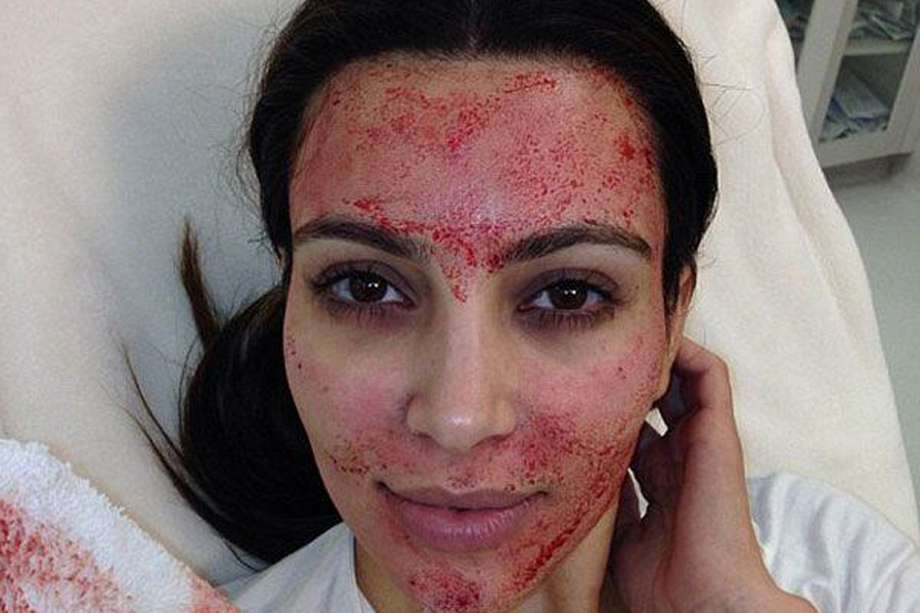 Kim Kardashian, tras su extraño tratamiento de belleza.