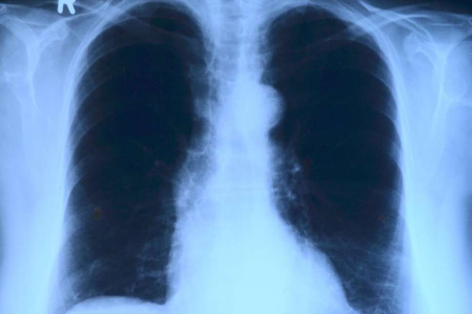 En 2022, el cáncer que más muertes causó fue el de pulmón.