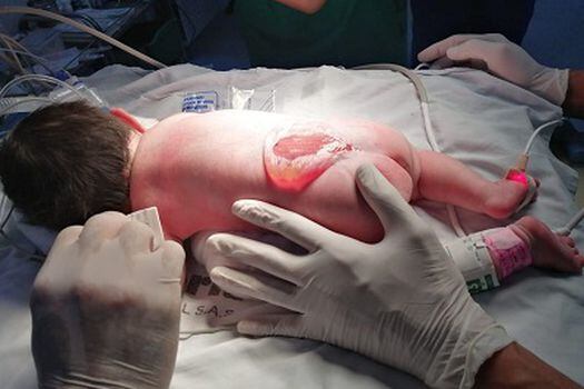 La malformación que presentaba la recién nacida ocurre, en promedio, en uno de cada 1.000 nacimientos.
