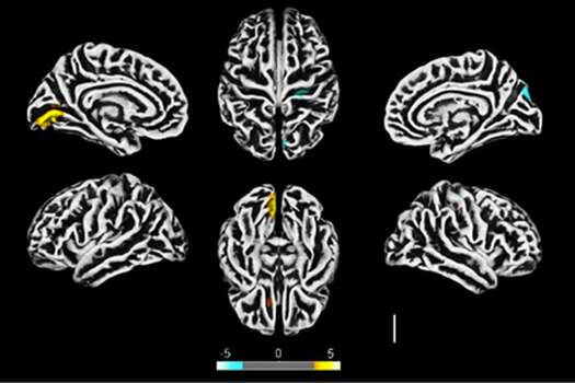 Investigadores brasileros usaron diferentes técnicas, entre ellas neuroimágenes, para evaluar los efectos del SARS-CoV-2 en el cerebro.