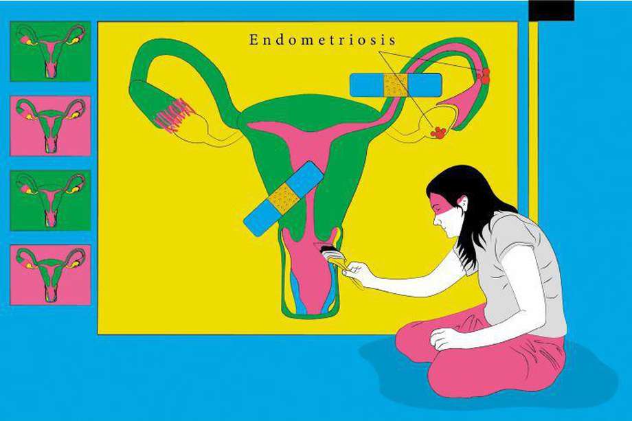 Imagen de referencia. Se estima que son más de 5 millones de colombianas, diagnosticadas o no, quienes sufren de endometriosis. 