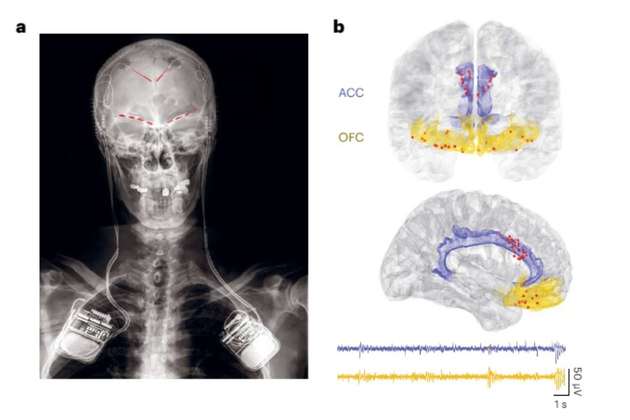 Hombre tetrapléjico vuelve a mover brazos por “puente digital” entre su médula y cerebro