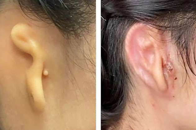 Médicos estadounidenses trasplantan oreja impresa en 3D y hecha de células humanas