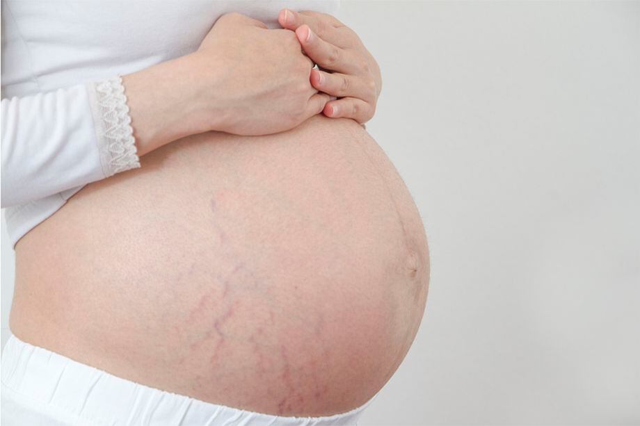 Uno de los cambios más normales en las mujeres embarazadas es la aparición de estrías. Te contamos por qué aparecen y cómo prevenirlas.