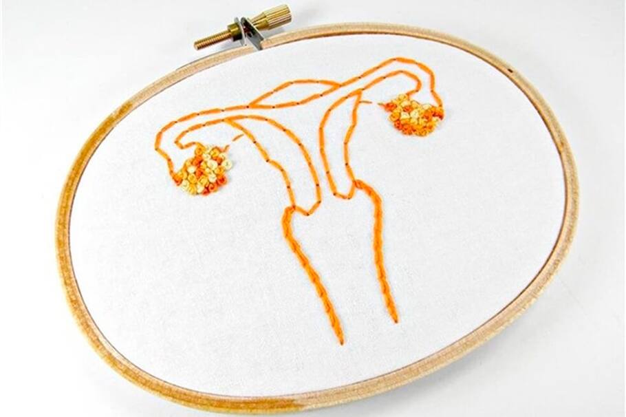 La histerectomía y el soporte de malla tienen resultados similares para el prolapso vaginal