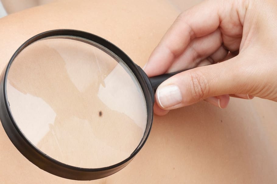 Lunares en casa. Cuidado de los lunares