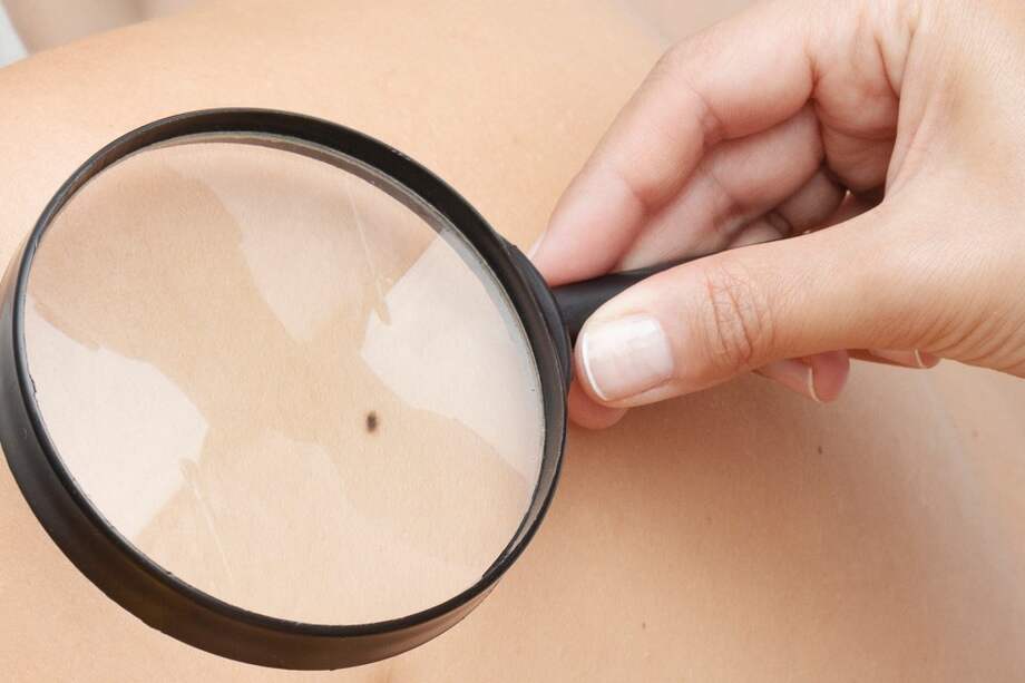 Según las cuentas de Alto Costo, en Colombia en el 2021, el promedio del tiempo de espera hasta la obtención del diagnóstico del melanoma fue de 49 días y hasta el primer tratamiento de 83 días.