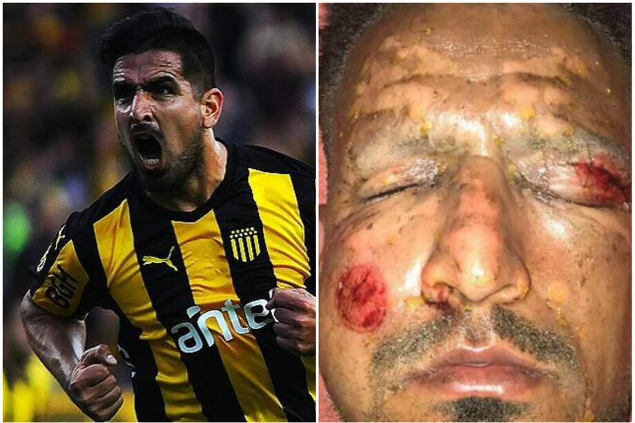 Ojo de Lucas Viatri está fuera de peligro tras accidente con pólvora