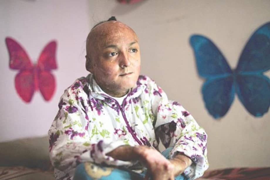 Jessica Ramírez es la primera colombiana con una enfermedad rara que recibe medidas cautelares de la CIDH. / Luis Ángel