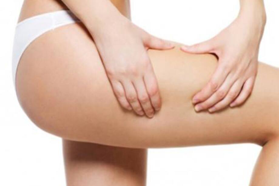 Evita la aparición de estrías siguiendo estos consejos