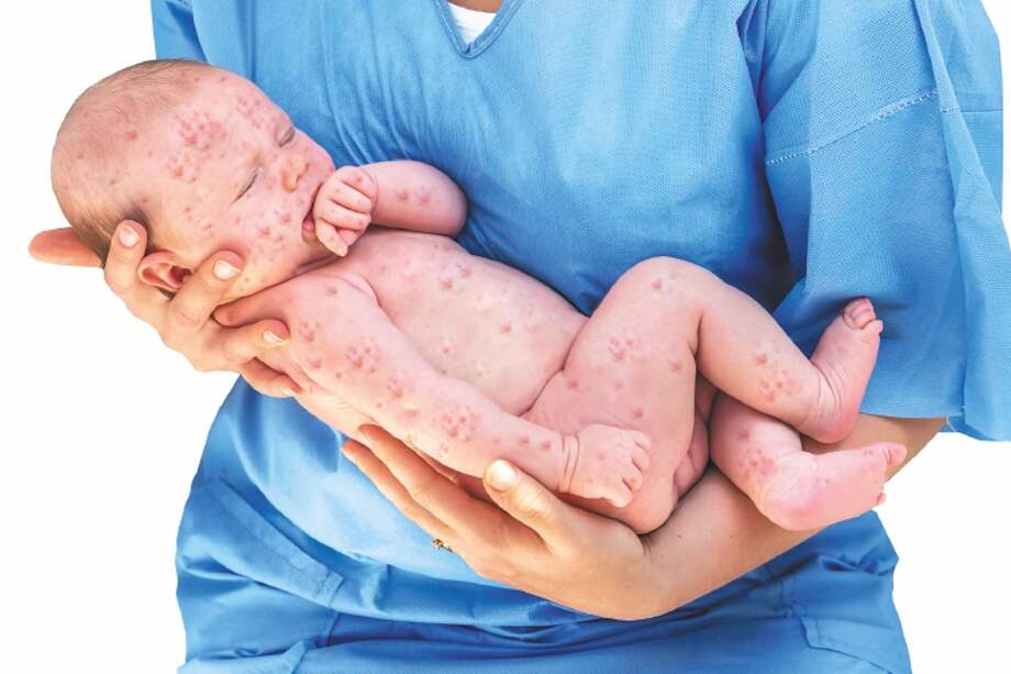 El sarampión es la quinta enfermedad erradicada en América gracias a las vacunas y jornadas de prevención. / iStock