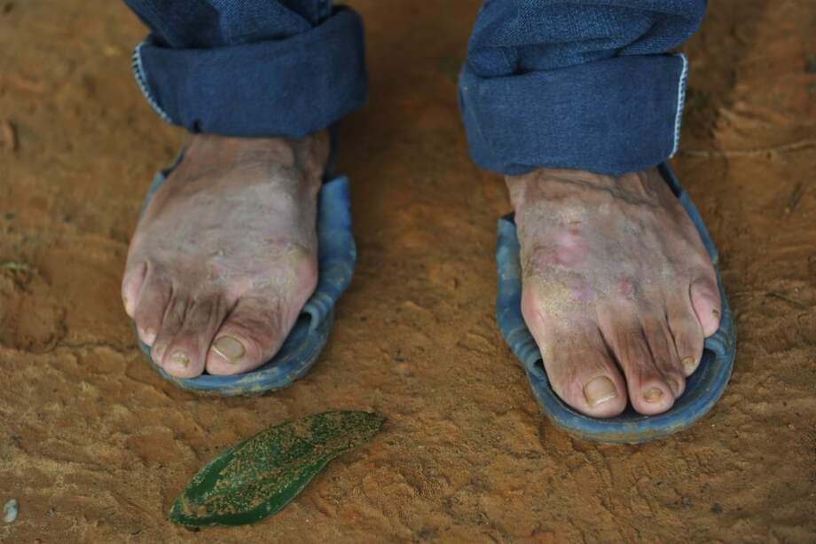 El níquel es una causa común de dermatitis en el mundo.