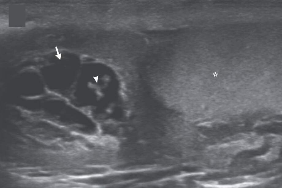 En la investigación, los médicos explicaron que encontraron a los gusanos ‘bailando’, lo que “representa las ondulaciones de los gusanos vivos.