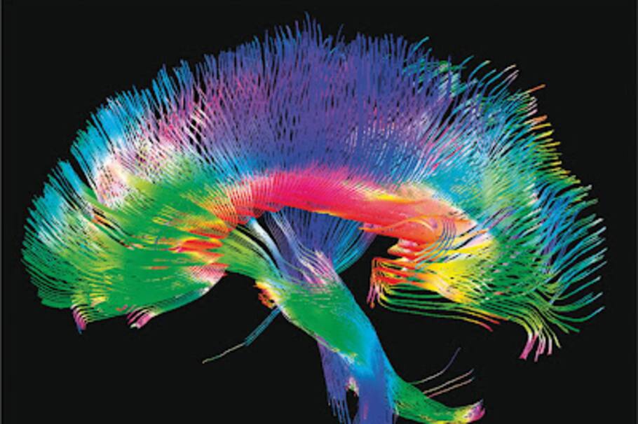 Mucopolisacaridosis Tipo 1