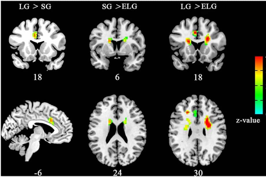 Así se ven las resonancias que tomaron los científicos, donde se muestran las áreas cerebrales que podrían estar involucradas con el amor. / www.frontiersin.org