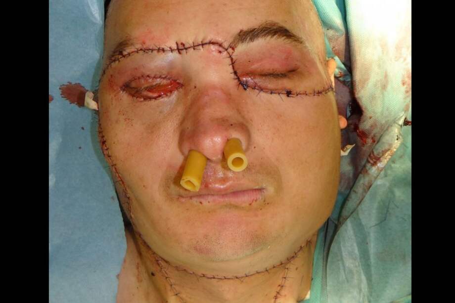 Imagen facilitada por el centro oncológico de Gliewice en la que se observa al paciente al que se le ha realizado el primer transplante total de cara en Polonia./ EFE