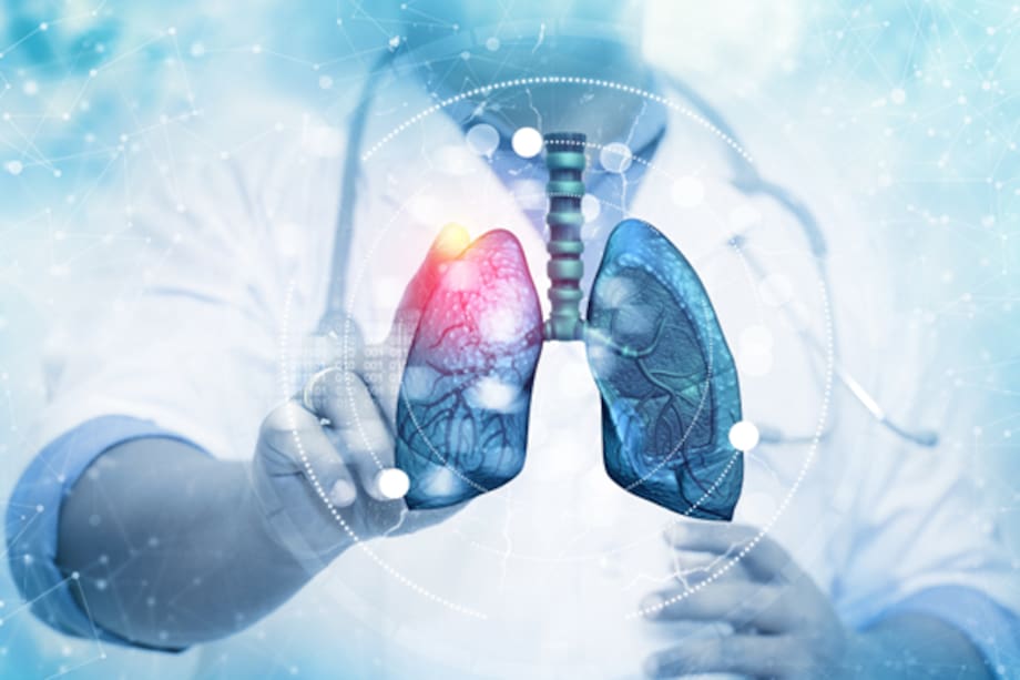 Más de la mitad de los casos de cáncer de pulmón se diagnostican en etapas avanzadas, reduciendo las opciones de tratamiento.