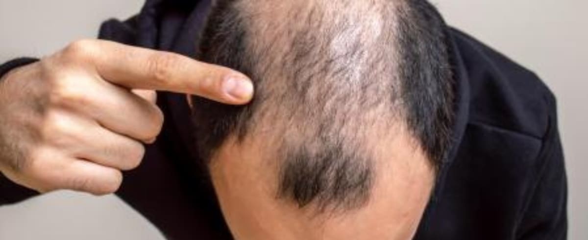 Soñar que me quedo calvo