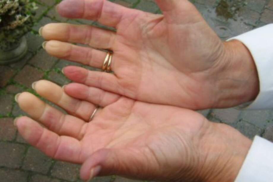 ¿Sabe qué es el fenómeno de Raynaud?