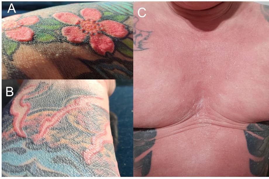 Etapa inicial de la enfermedad: (A,B) cambios en la piel dentro de la tinta roja del tatuaje en el antebrazo derecho; (C) eritrodermia y alopecia universal.